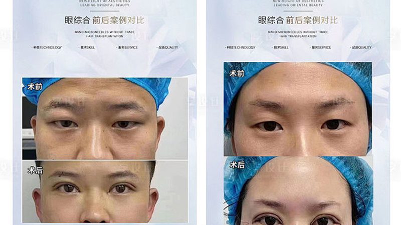 光子嫩肤仪器：揭秘参数与型号背后的技术奥秘