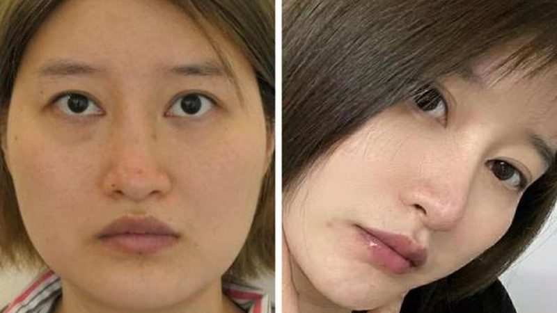 玻尿酸代理加盟，如何规避这些常见误区？**