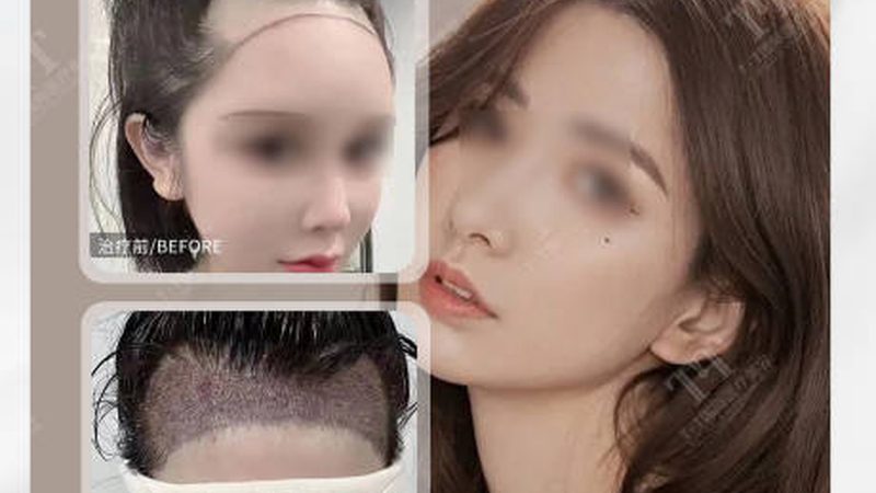 轻医美与医疗美容：恢复速度大揭秘