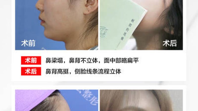 激光祛斑效果能维持多久？揭秘祛斑后的长效保持秘诀